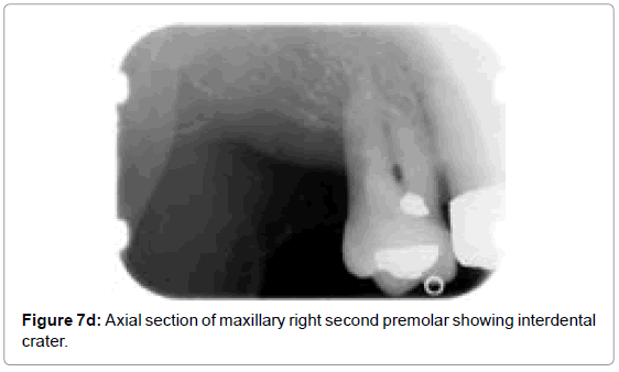 oral-hygiene-health-axial-section-maxillary-right