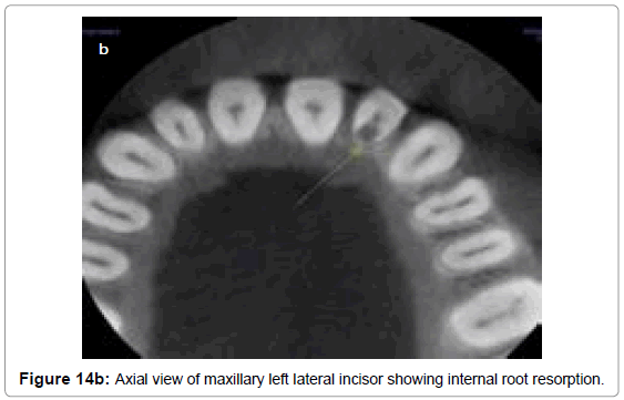 oral-hygiene-health-axial-view-maxillary-incisor