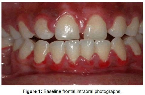oral-hygiene-health-baseline-frontal-intraoral