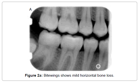 oral-hygiene-health-bitewing-mild-bone-loss