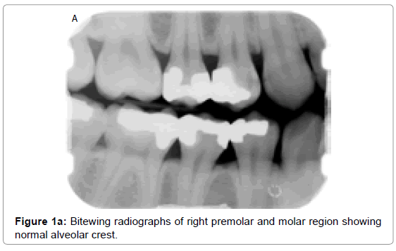 oral-hygiene-health-bitewing-radiographs-right
