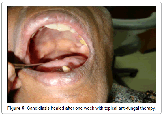 oral-hygiene-health-candidiasis-healed
