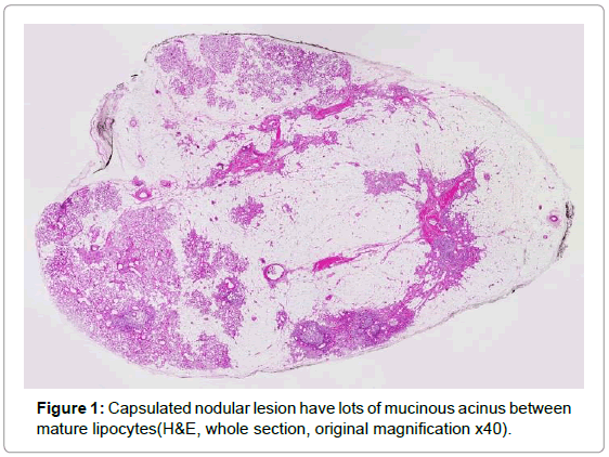 oral-hygiene-health-capsulated-nodular-lesion