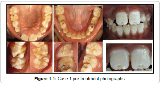 oral-hygiene-health-case-1-pre-treatment