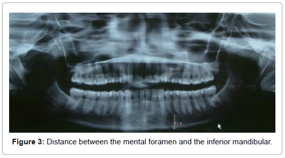 oral-hygiene-health-distance-mental-foramen
