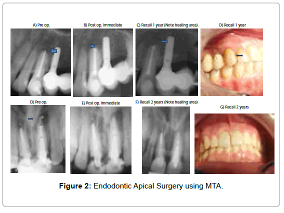 oral-hygiene-health-endodontic-apical