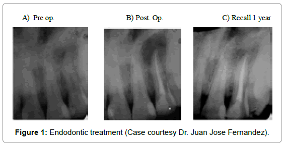 oral-hygiene-health-endodontic-treatment
