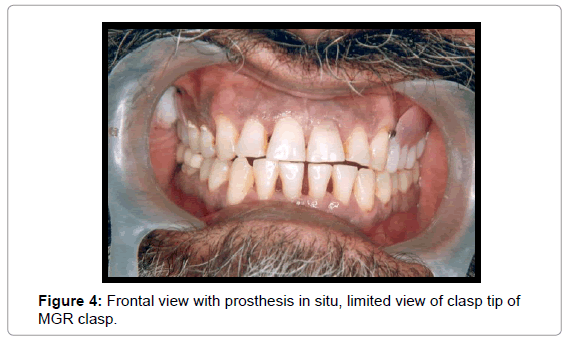 oral-hygiene-health-frontal-view-prosthesis