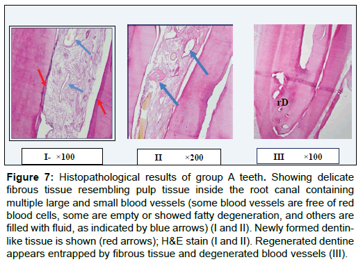 oral-hygiene-health-histopathological-fibrous-tissue