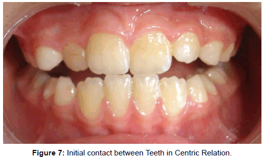 oral-hygiene-health-initial-contact-teeth