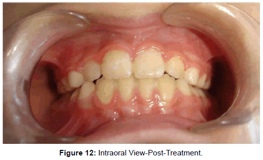 oral-hygiene-health-intraoral-post-treatment
