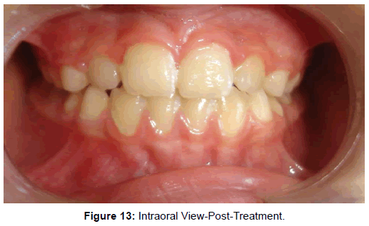 oral-hygiene-health-intraoral-post-treatment