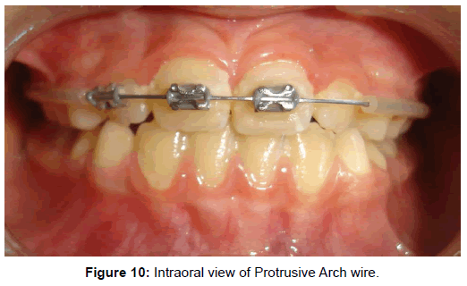 oral-hygiene-health-intraoral-protrusive-arch