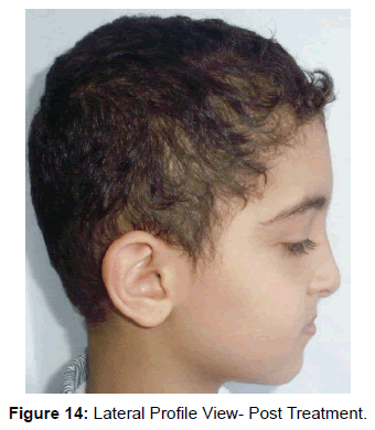 oral-hygiene-health-lateral-profile-view