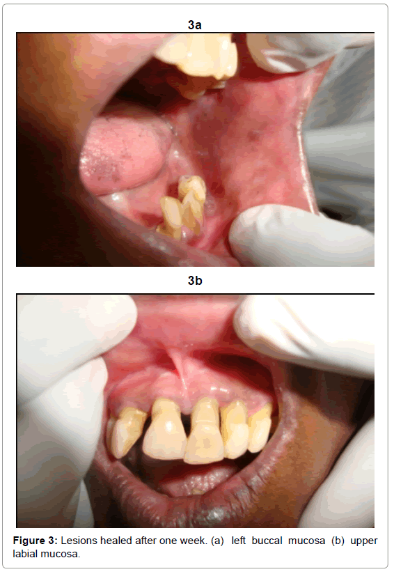 oral-hygiene-health-lesions-healed-mucosa