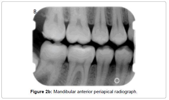 oral-hygiene-health-mandibular-anterior-periapical