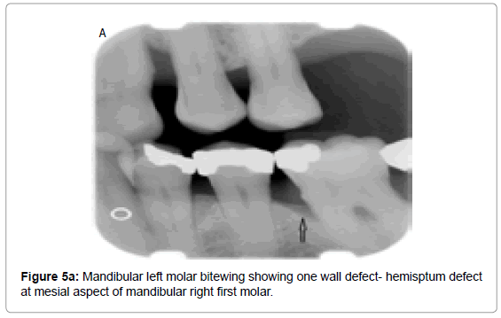 oral-hygiene-health-mandibular-left-molar