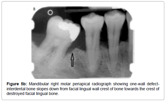 oral-hygiene-health-mandibular-right-molar