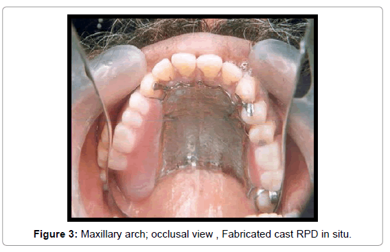 oral-hygiene-health-maxillary-arch-fabricated