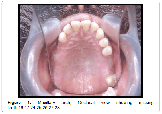 oral-hygiene-health-maxillary-arch-missing