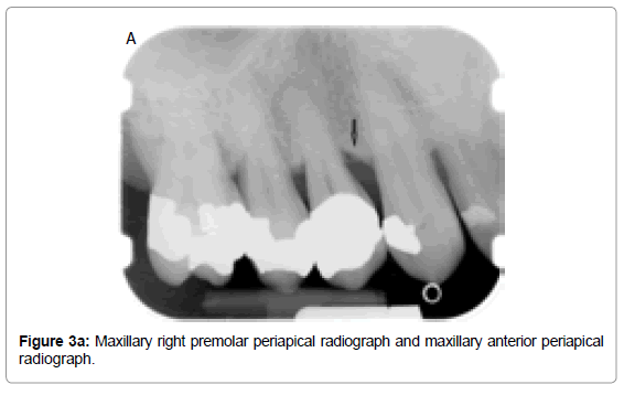 oral-hygiene-health-maxillary-right-premolar
