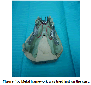 oral-hygiene-health-metal-framework-cast