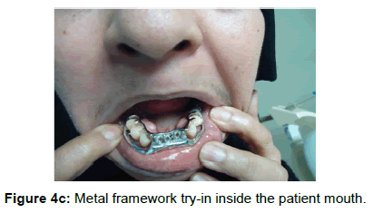 oral-hygiene-health-metal-framework-mouth