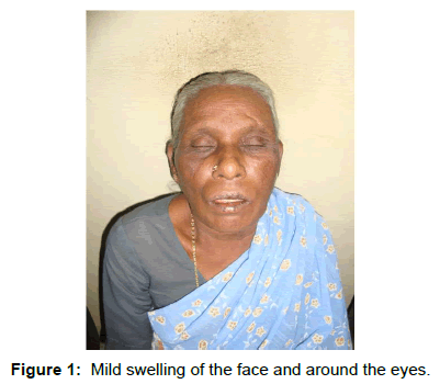 oral-hygiene-health-mild-swelling-face
