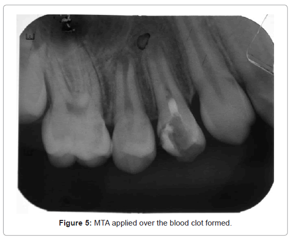 oral-hygiene-health-mta-applied-clot-formed