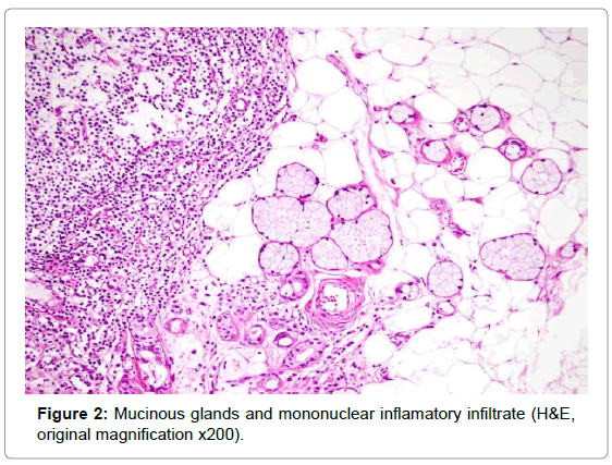 oral-hygiene-health-mucinous-glands-inflamatory