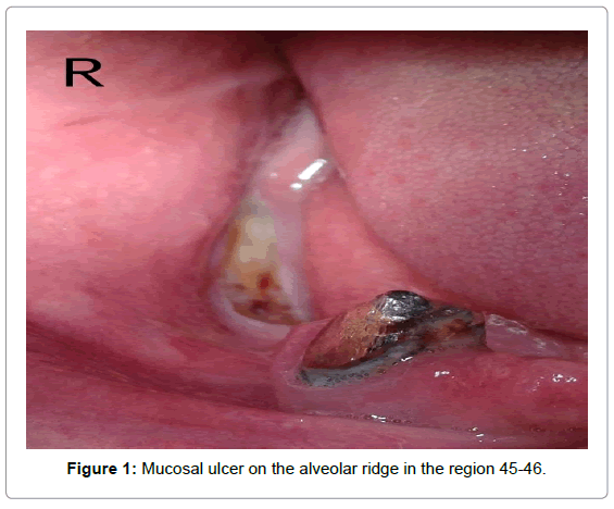 oral-hygiene-health-mucosal-ulcer-alveolar
