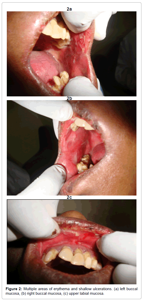 oral-hygiene-health-multiple-areas-erythema