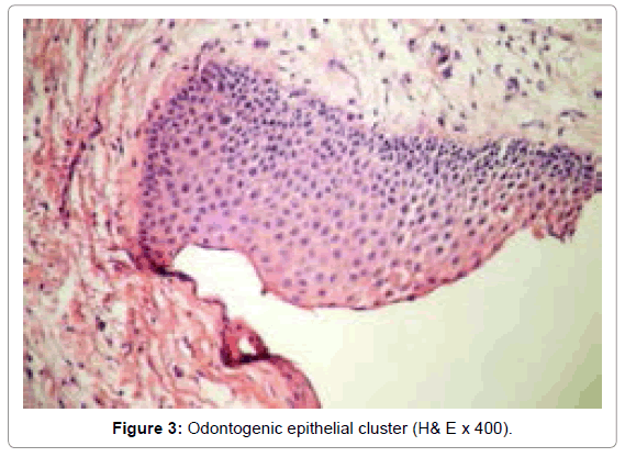 oral-hygiene-health-odontogenic-epithelial-cluster