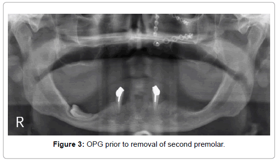 oral-hygiene-health-opg-prior-premolar