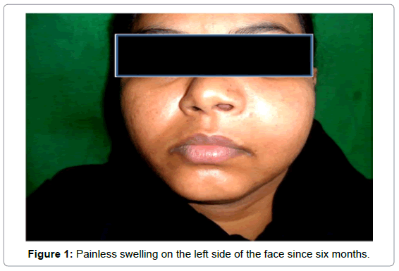 oral-hygiene-health-painless-swelling