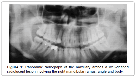 oral-hygiene-health-panoramic-radiolucent-lesion