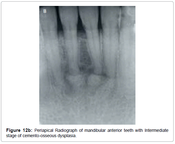 oral-hygiene-health-periapical-radiograph-anterior