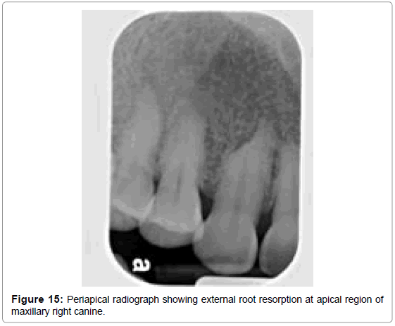 oral-hygiene-health-periapical-radiograph-external