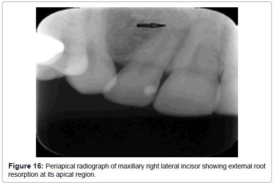 oral-hygiene-health-periapical-radiograph-incisor