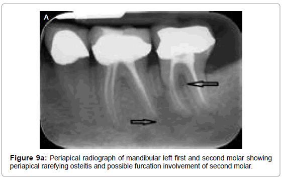 oral-hygiene-health-periapical-radiograph-mandibular