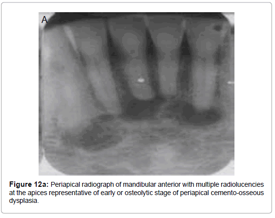 oral-hygiene-health-periapical-radiograph-mandibular