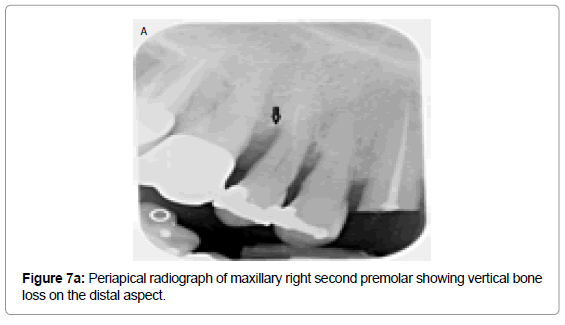 oral-hygiene-health-periapical-radiograph-maxillary