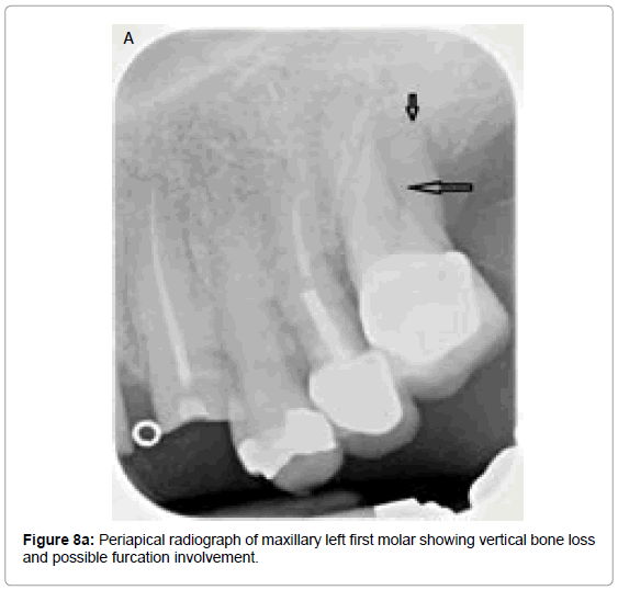 oral-hygiene-health-periapical-radiograph-maxillary