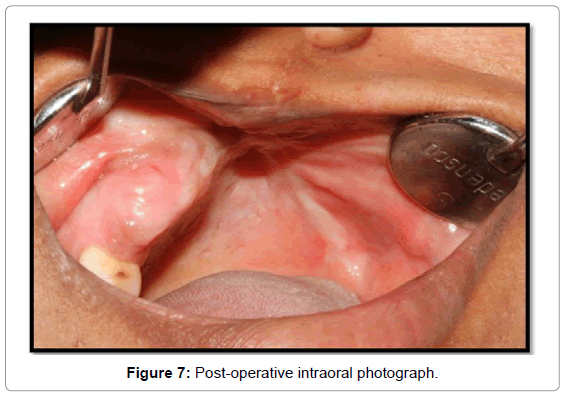 oral-hygiene-health-post-operative