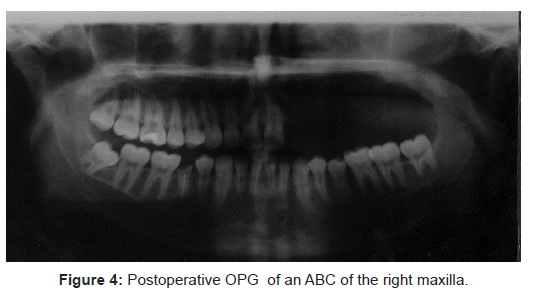 oral-hygiene-health-postoperative-opg-abc