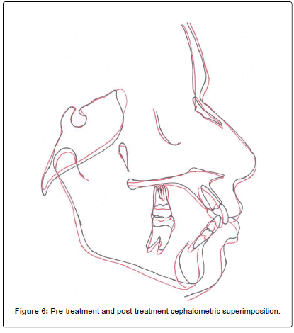 oral-hygiene-health-pre-debonding-right-lateral