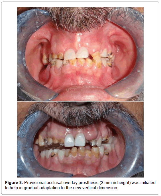 oral-hygiene-health-provisional-occlusal
