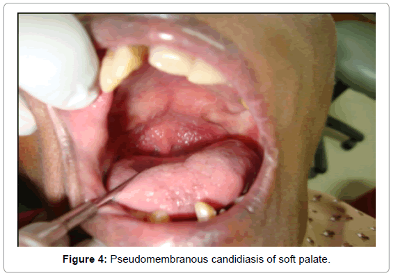 oral-hygiene-health-pseudomembranous-soft