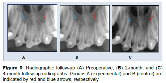 oral-hygiene-health-radiographic-indicated-blue
