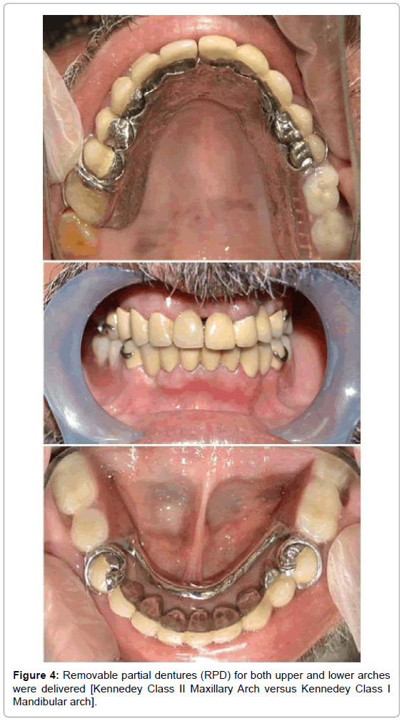 oral-hygiene-health-removable-dentures